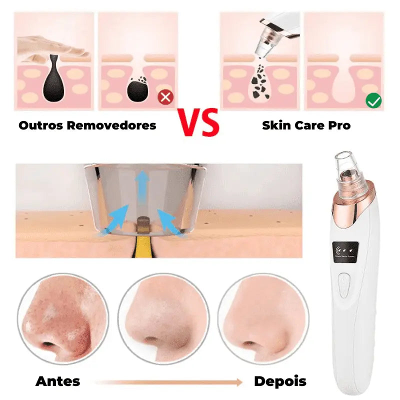 Removedor de Cravos e Espinhas Elétrico PureSkin Pro